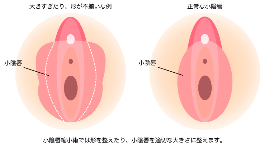 小陰唇手術