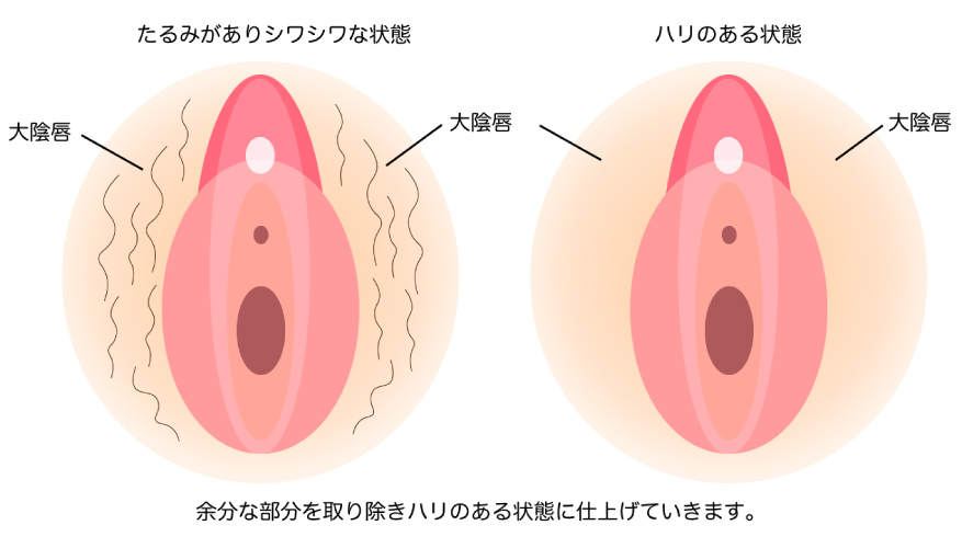 大陰唇たるみ取り縫い