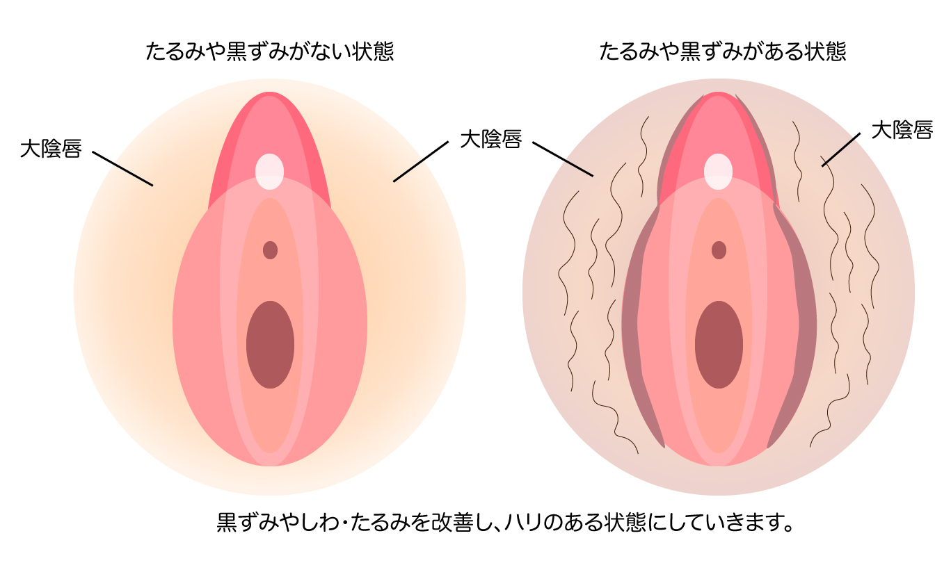 Iライン色調改善