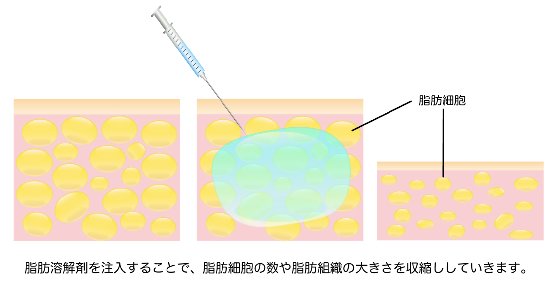 脂肪溶解注射