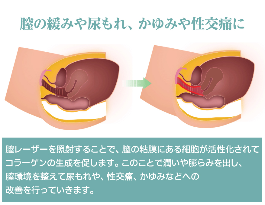 膣トリートメント